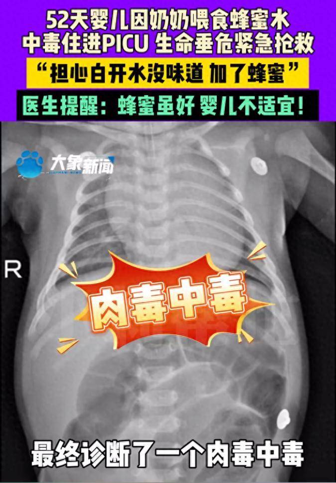 皇冠信用网登2代理_52天婴儿喝奶奶喂的蜂蜜水后中毒进ICU皇冠信用网登2代理,医生提醒:1岁以下婴儿不宜食用蜂蜜