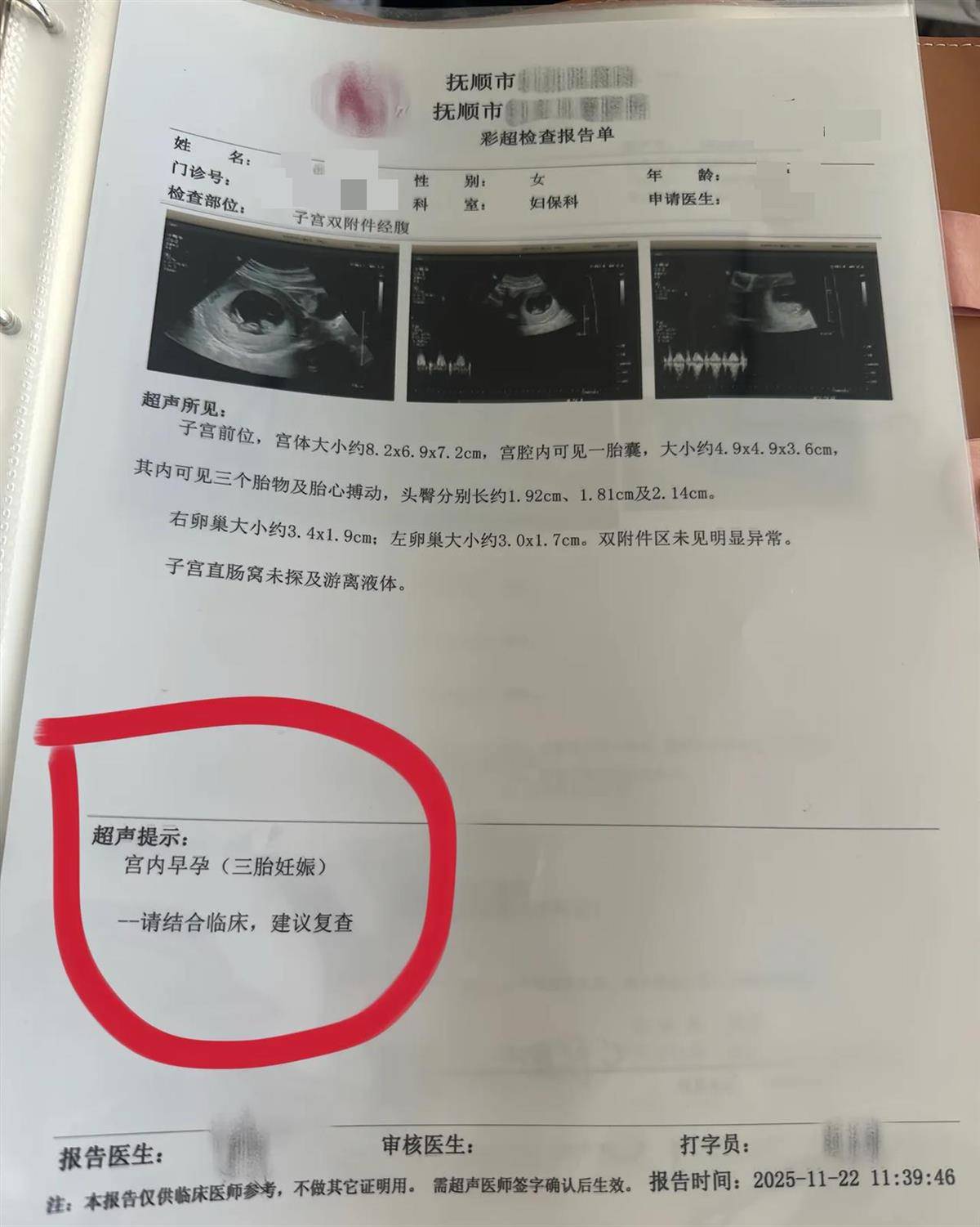 洛斯查兰特vs域堡
_辽宁一孕妇两个月内从一胎变四胞胎洛斯查兰特vs域堡
,每次产检发现多出一胎,医生:系同卵四胞胎,概率1300万至1500万分之一